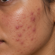 Blemish-prone skin