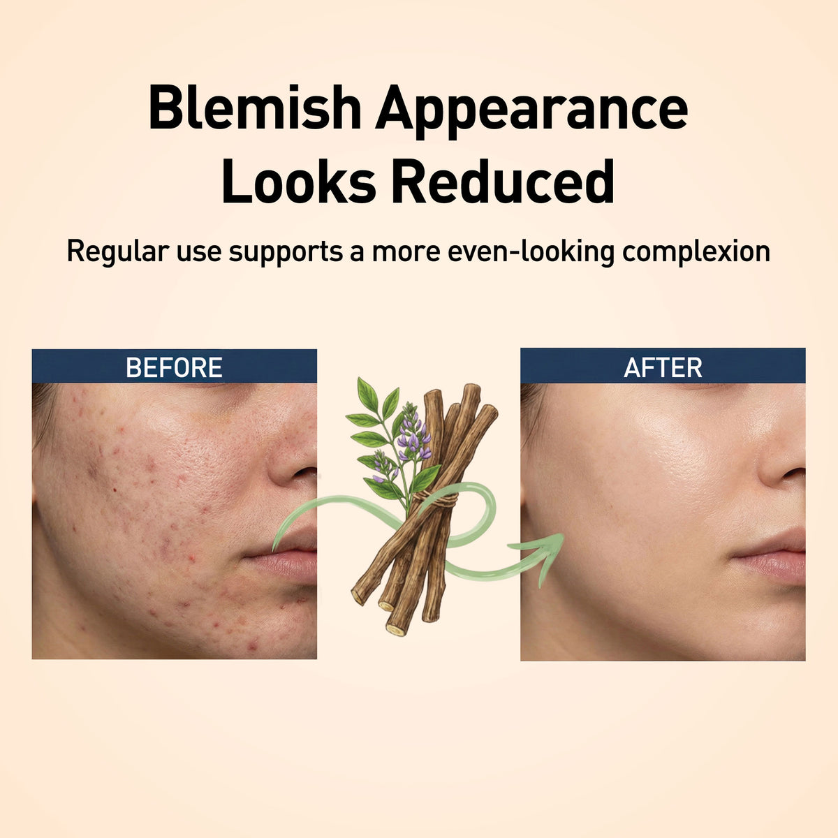Before and after comparison of skin with blemishes, showing reduced appearance with regular use, on a beige background.